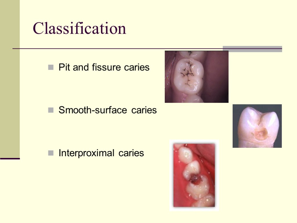 Classification Pit and fissure caries Smooth-surface caries Interproximal caries